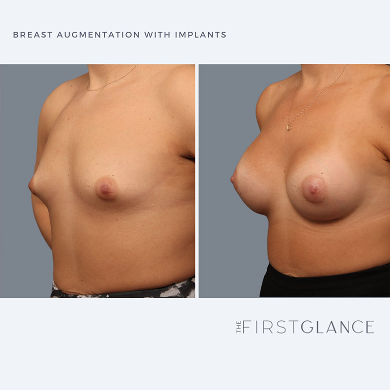 FirstGalnce-BreastAugmentation-Case1-2