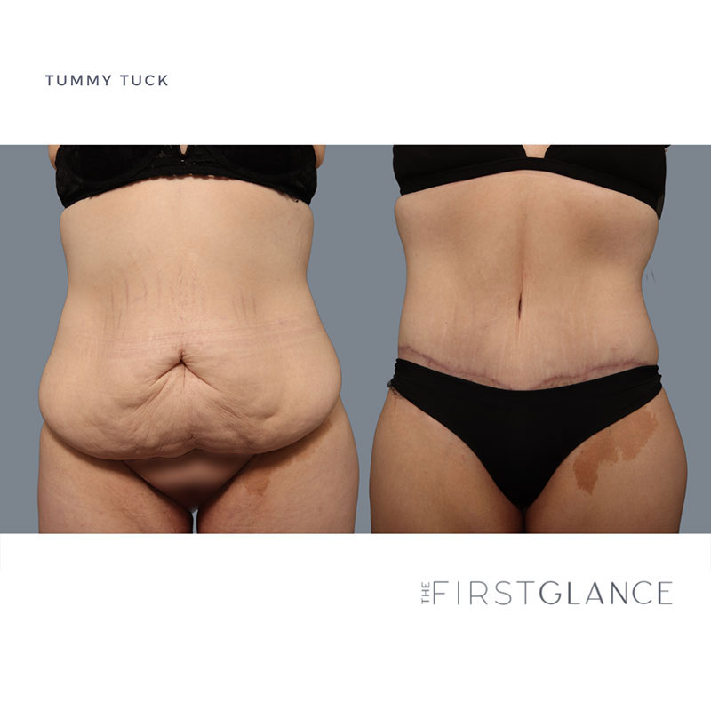 FirstGlance-TummyTuck-Case1-1