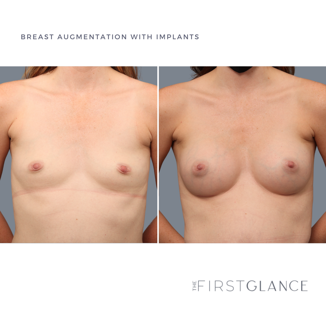 FirstGlance-Breast-Aug-Implant-Case1-1