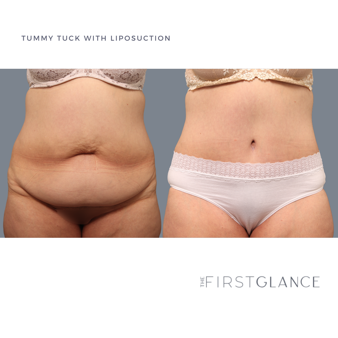 FirstGlance-TummyTuck-Case5-1