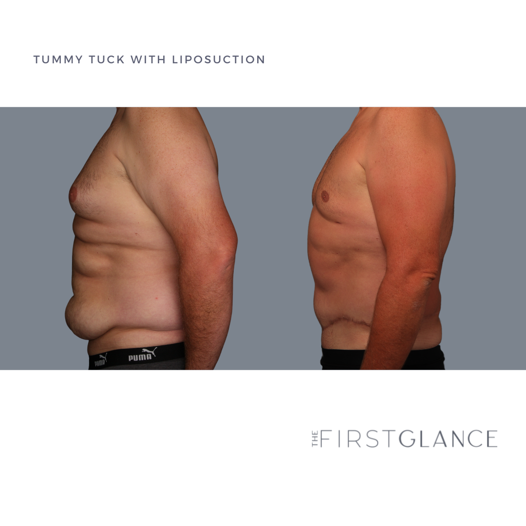 FirstGlance-TummyTuck-Lipo-BodyTite-Case1-4