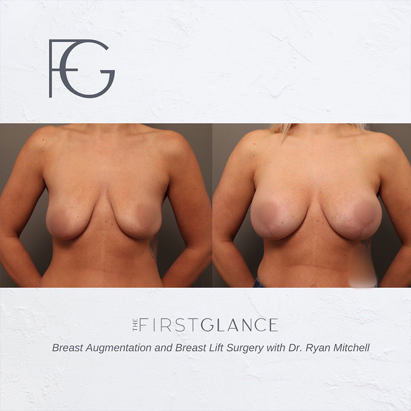 FG-breast-augmentation-lift-case-b-1