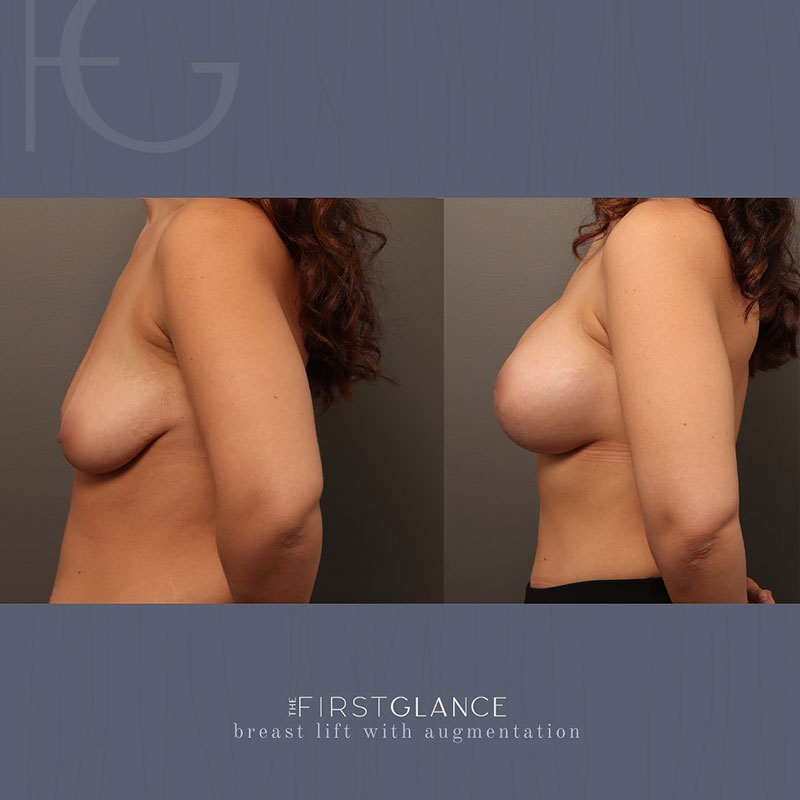 FG-breast-augmentation-lift-case-c-3