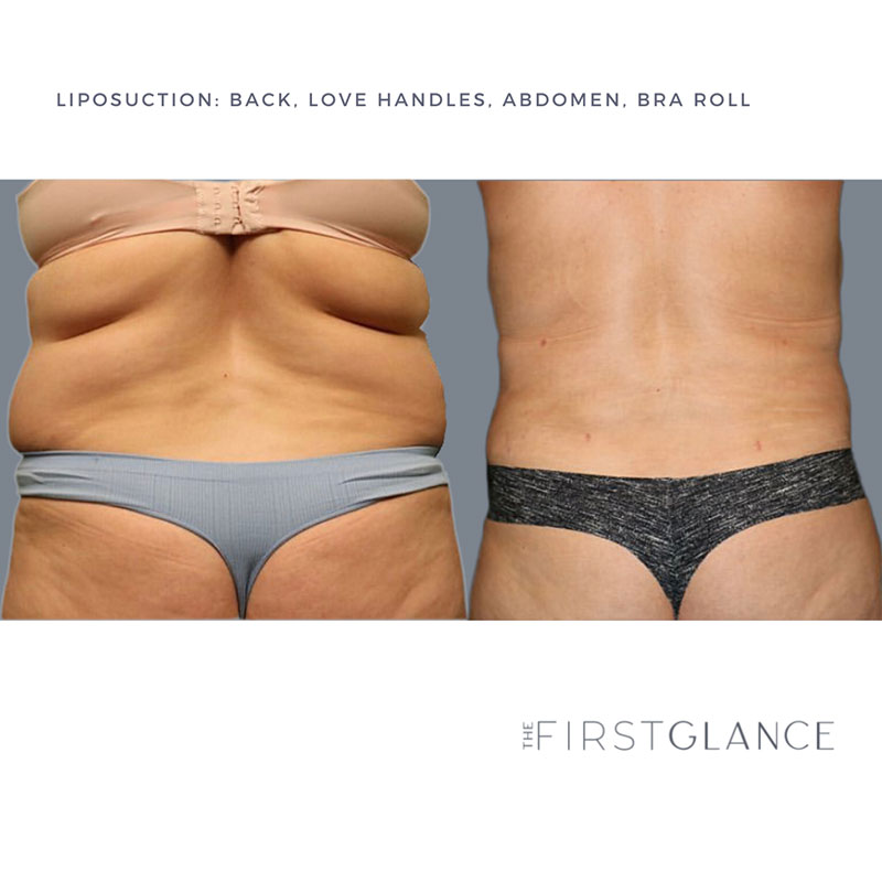 First Glance Aesthetic Clinic Liposuction Before and After Case 7