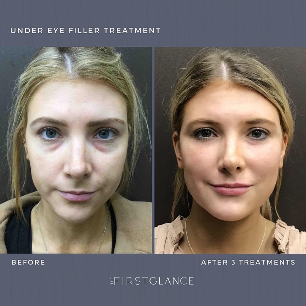 First Glance Aesthetic Clinic Under Eye Fillers