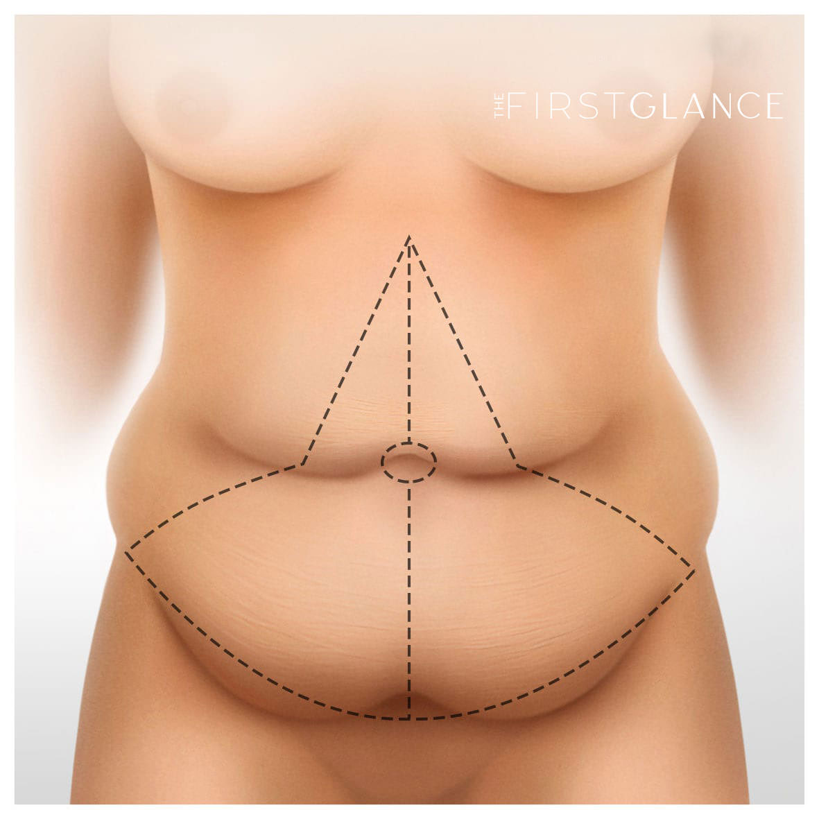 First Glance Aesthetic Clinic tummy tuck
