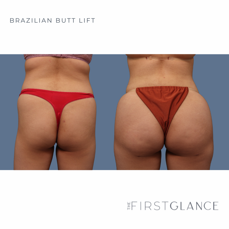 WEBSITE ONLY Brazilian Butt Lift (1)