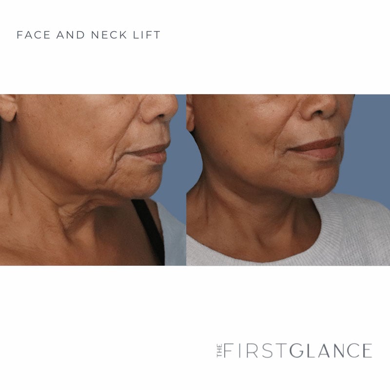 Top-FaceLift-Surgeon-Winnipeg,-Canada