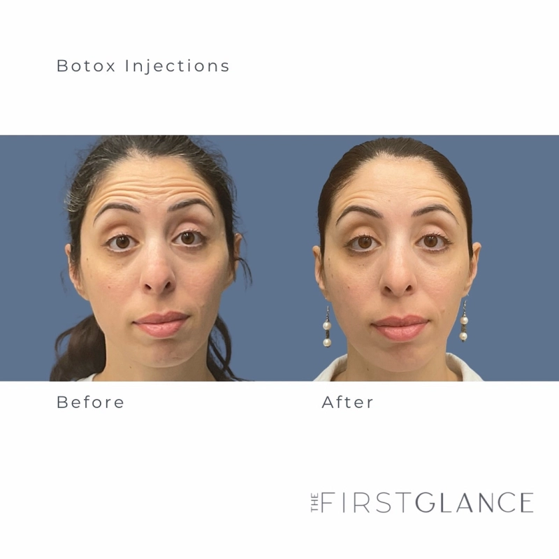 Before & After Botox & Neuromodulator Winnipeg, MB