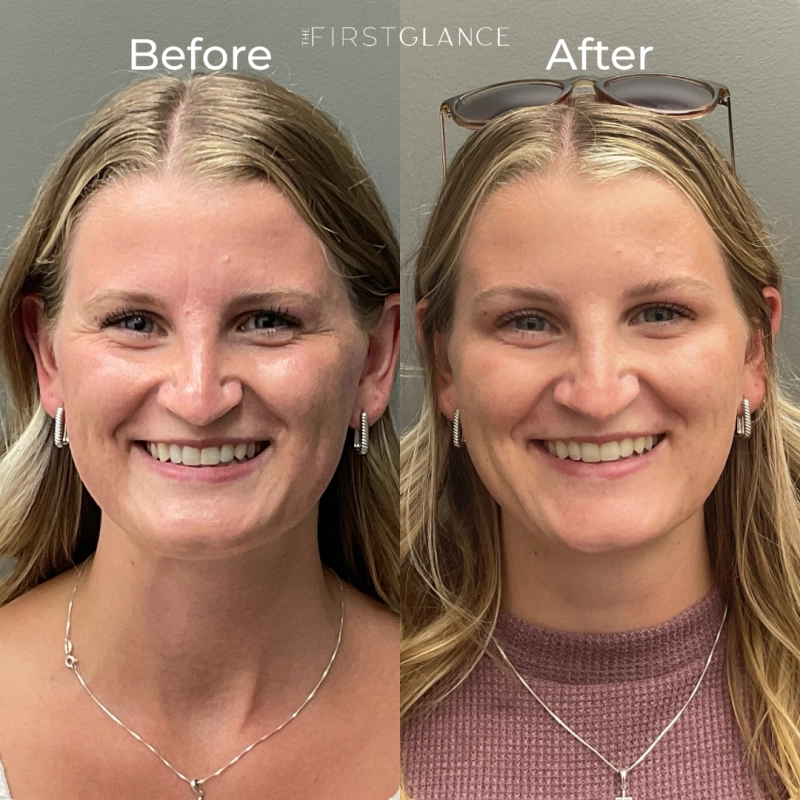 Before and After Photos of Botox in Winnipeg