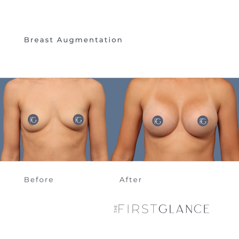 Before and After Photos of a Breast Augmentation in Winnipeg