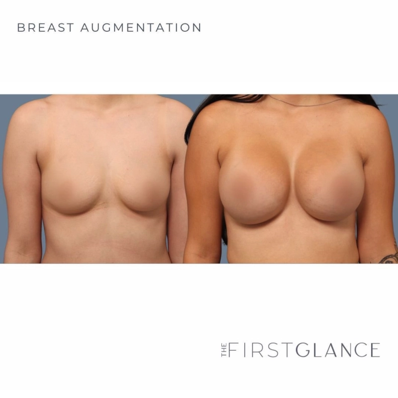 Before and After Photos of a Breast Augmentation in Winnipeg