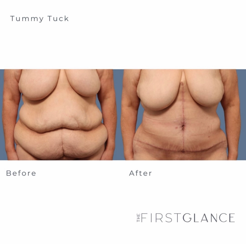 Before and After Photos of a Tummy Tuck in Winnipeg