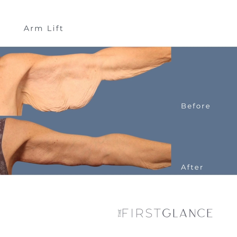 Before and After Photos of an Arm Lift in Winnipeg