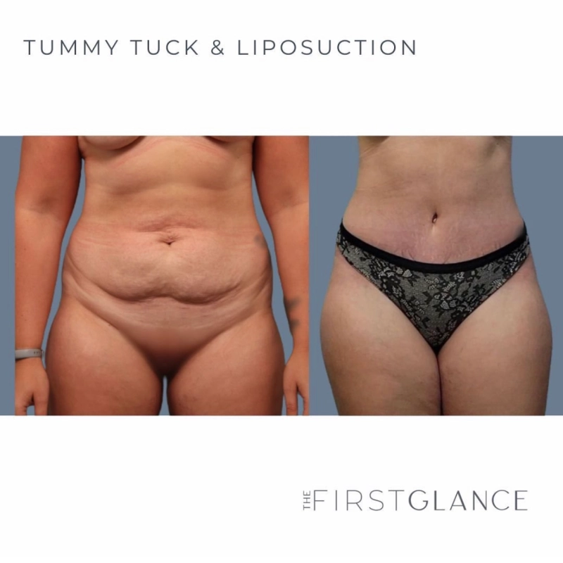 Before and After Tummy Tuck Board Certified Plastic Surgeon Winnipeg