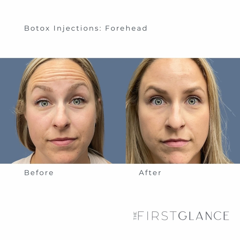 Botox Before & After Winnipeg