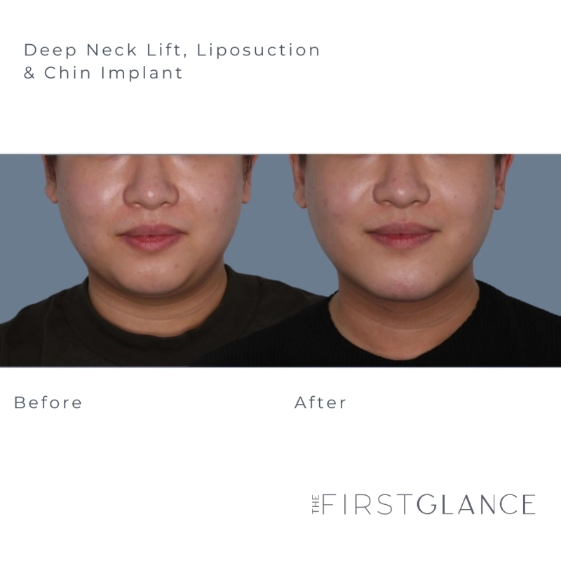 Chin Implant Before and After Photos in Winnipeg