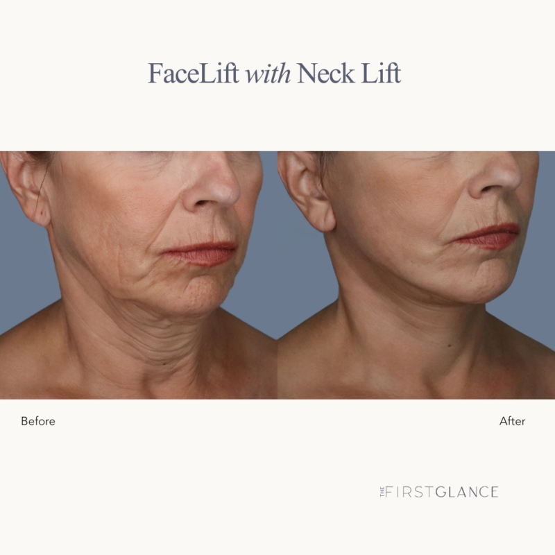 FaceLift & Neck Lift Before & After Photos in Winnipeg with Plastic Surgeon
