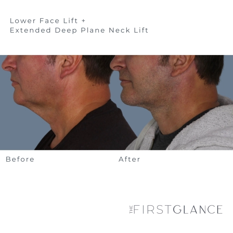 FaceLift and Neck Lift Before and After Photos