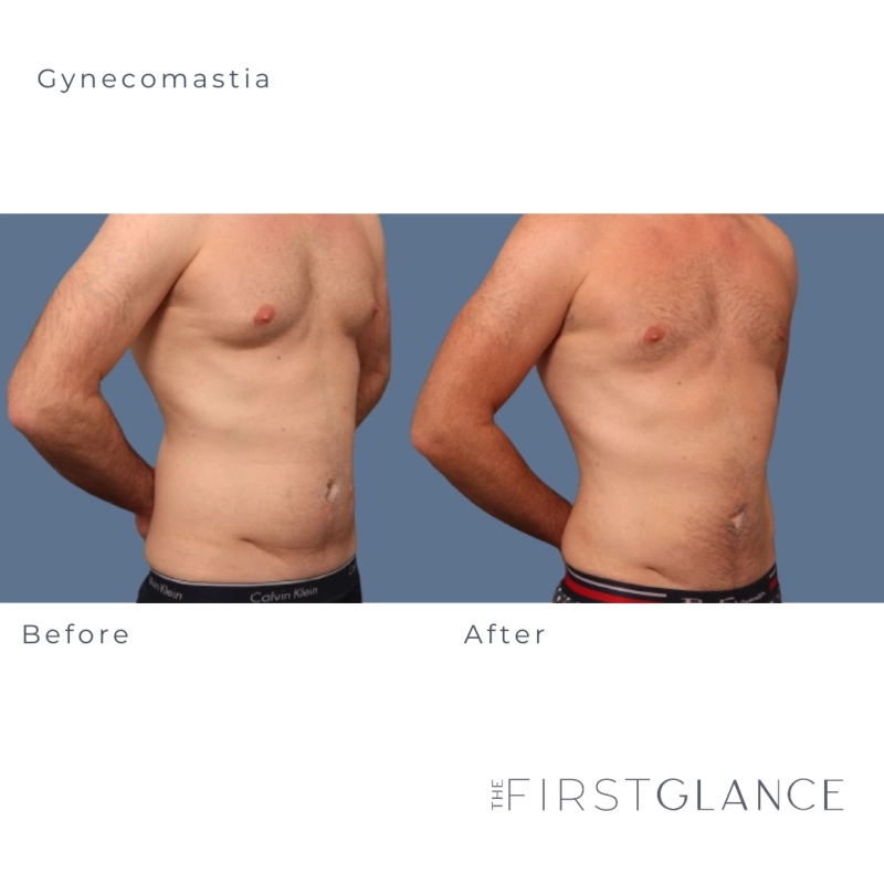 Gynecomastia Before and After Surgery in Winnipeg