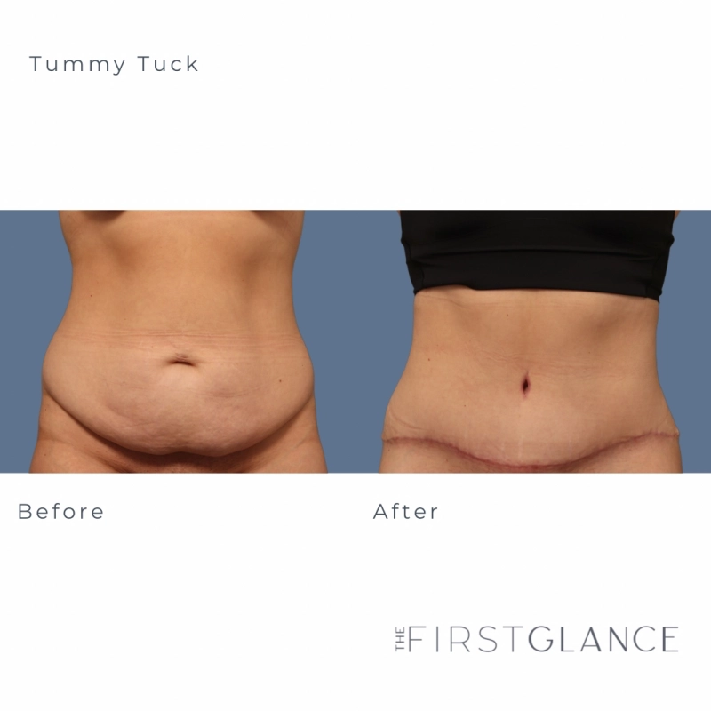 Tummy Tuck Winnipeg