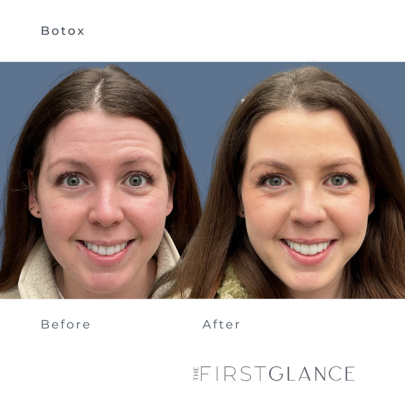 Before and After Botox Winnipeg