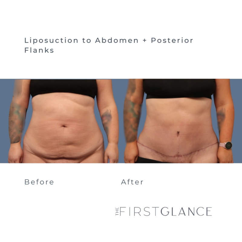 Before and After Photos of Liposuction in Winnipeg