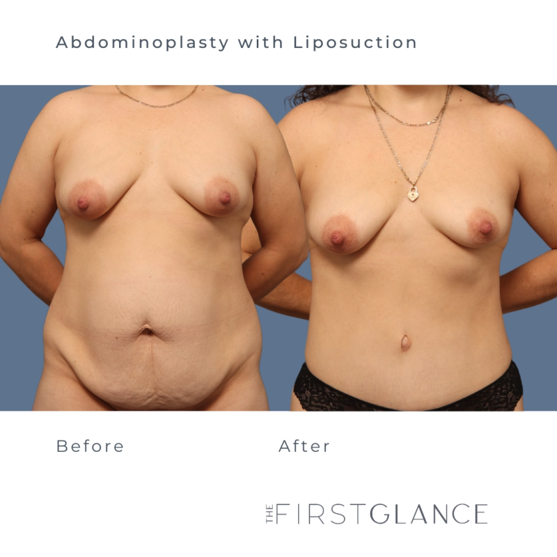 Before and After Photos of Tummy Tuck with Liposuction in Winnipeg
