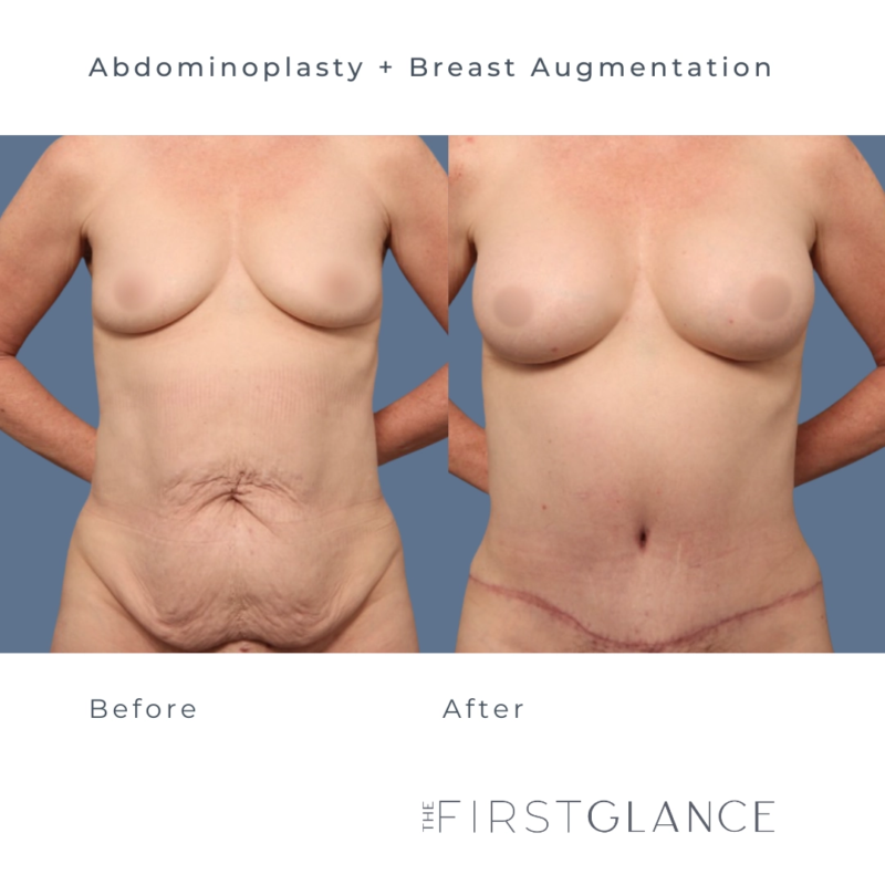 Before and After photos of a Tummy Tuck and Breast Augmentation in Winnipeg