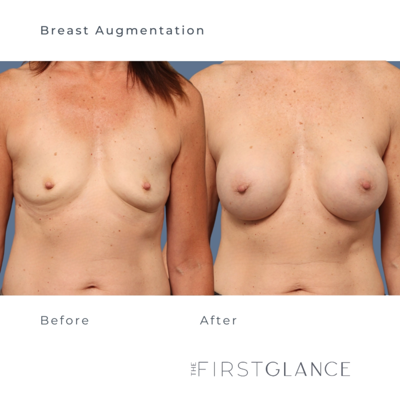 Breast Augmentaion Before and After in Winnipeg