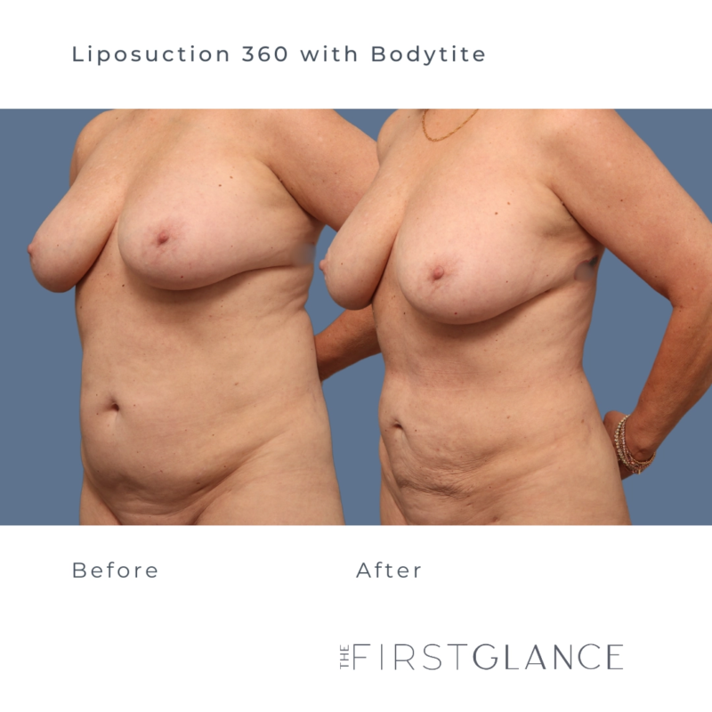 The FIrst Glance Before and After Photos of Liposuction