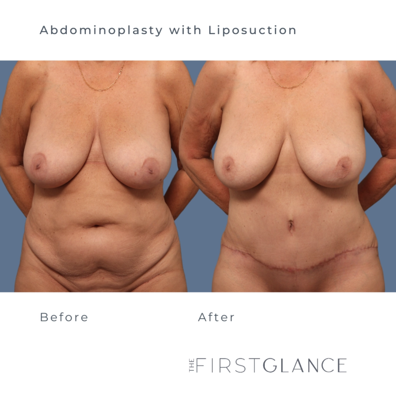 Tummy Tuck Before and After Photos in Winnipeg