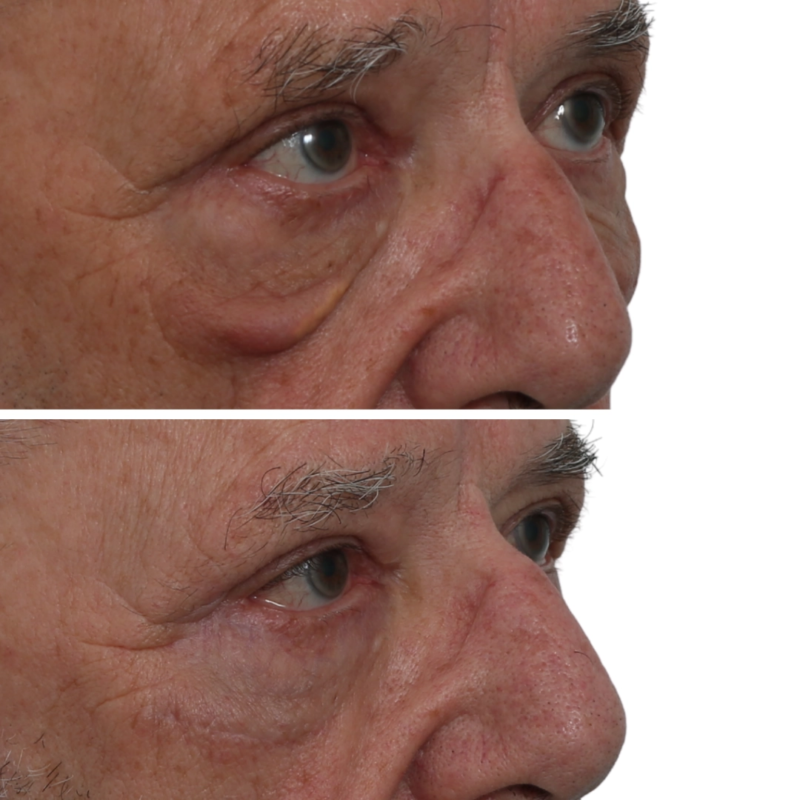 Before & After Eyelid Surgery Lower Eyelid in Winnipeg, MB