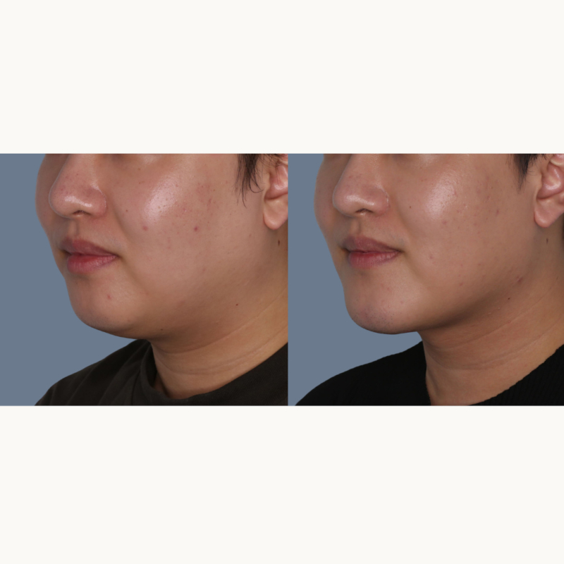 Before & After Neck Lift Photos Winnipeg