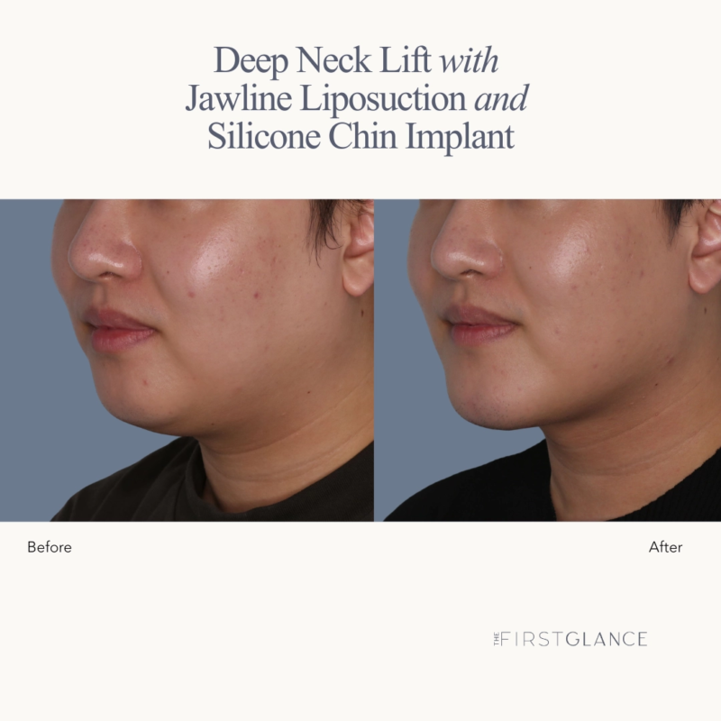 Neck Lift, Neck Liposuction, Chin Implant Before & After in Winnipeg, MB