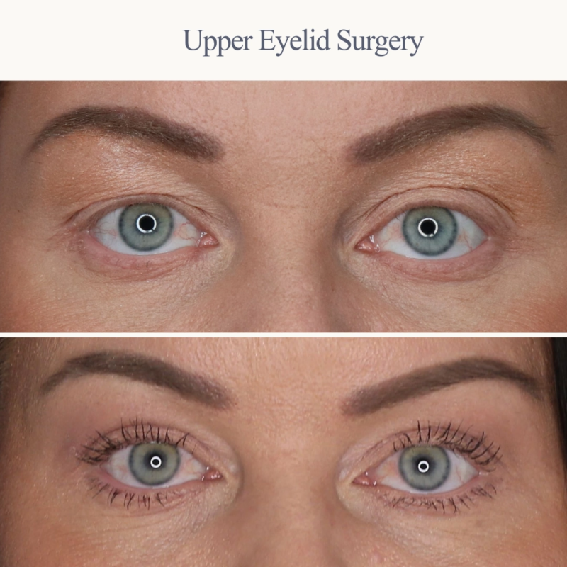 Upper Eyelid Surgery Before & After Photos in Winnipeg, MB Plastic Surgeon