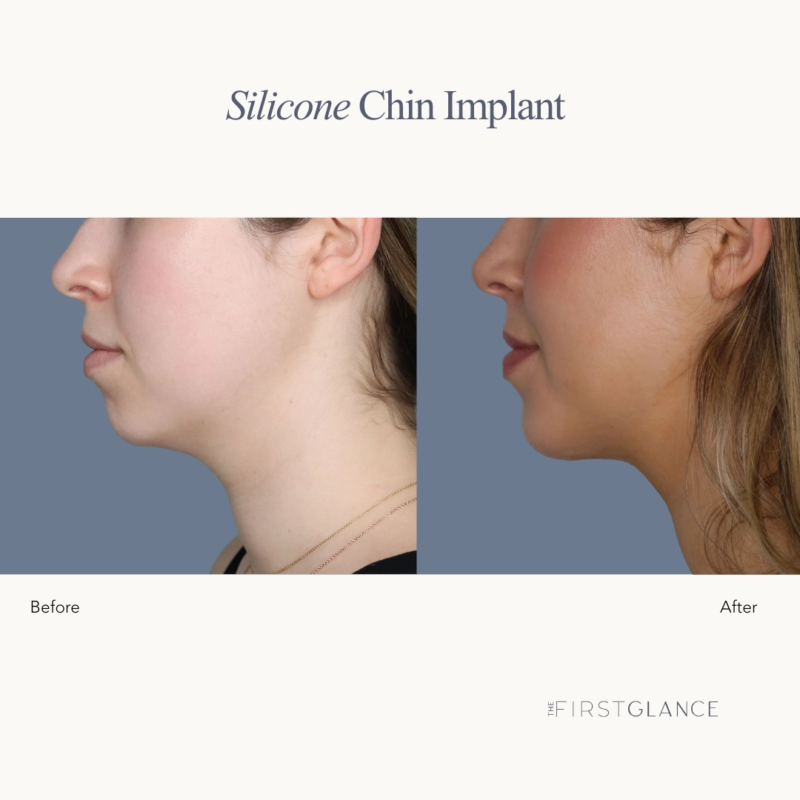 Before & After Chin Implant Winnipeg, MB