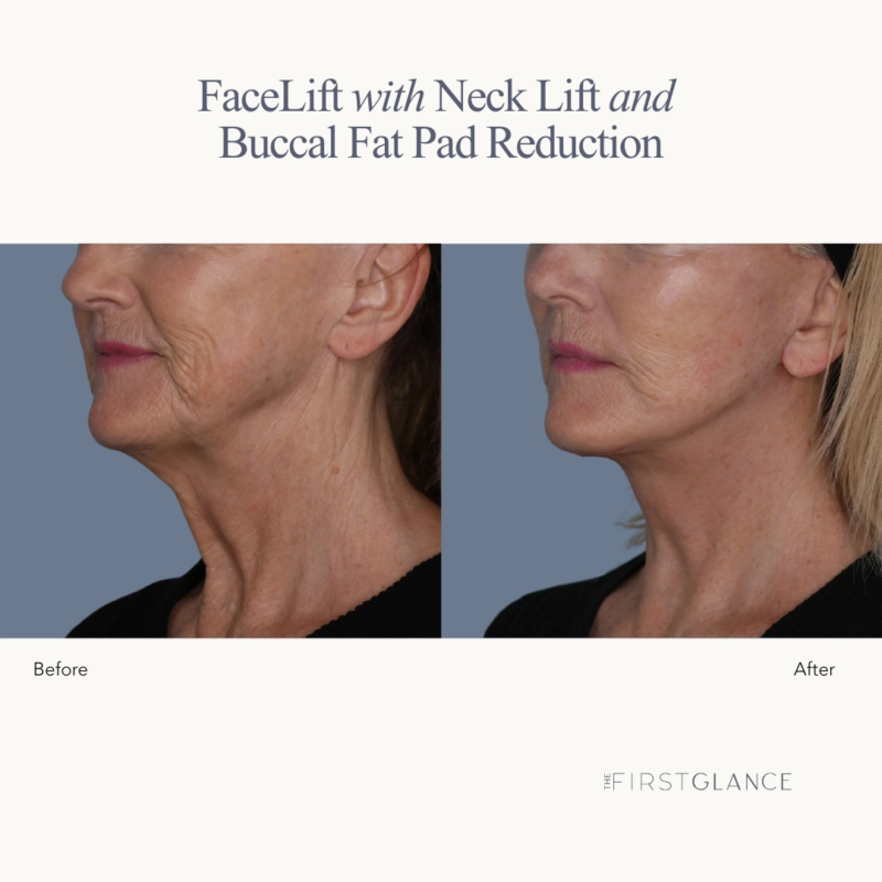 Before & After FaceLift, Neck Lift Surgery in Winnipeg, MB,
