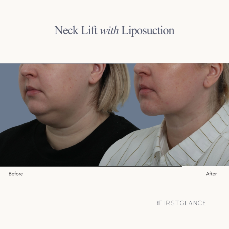 Before & After Neck Lift with Neck Liposuction in Winnipeg, MB Plastic Surgeon