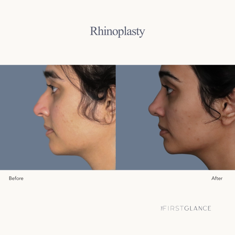 Before & After Nose Job Rhinoplasty Winnipeg, MB