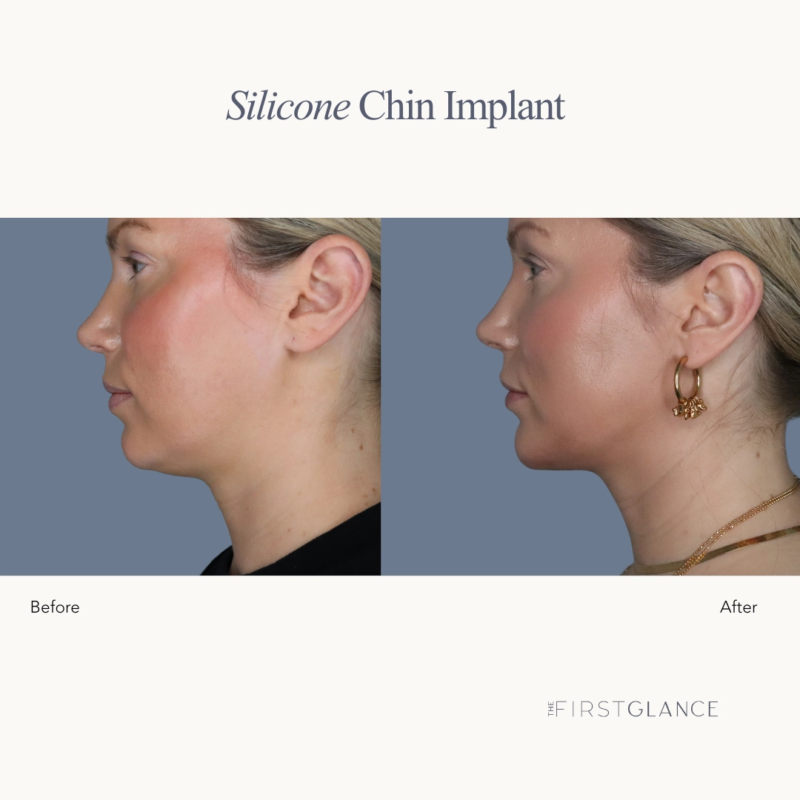 Chin Implant Before & After Winnipeg, MB