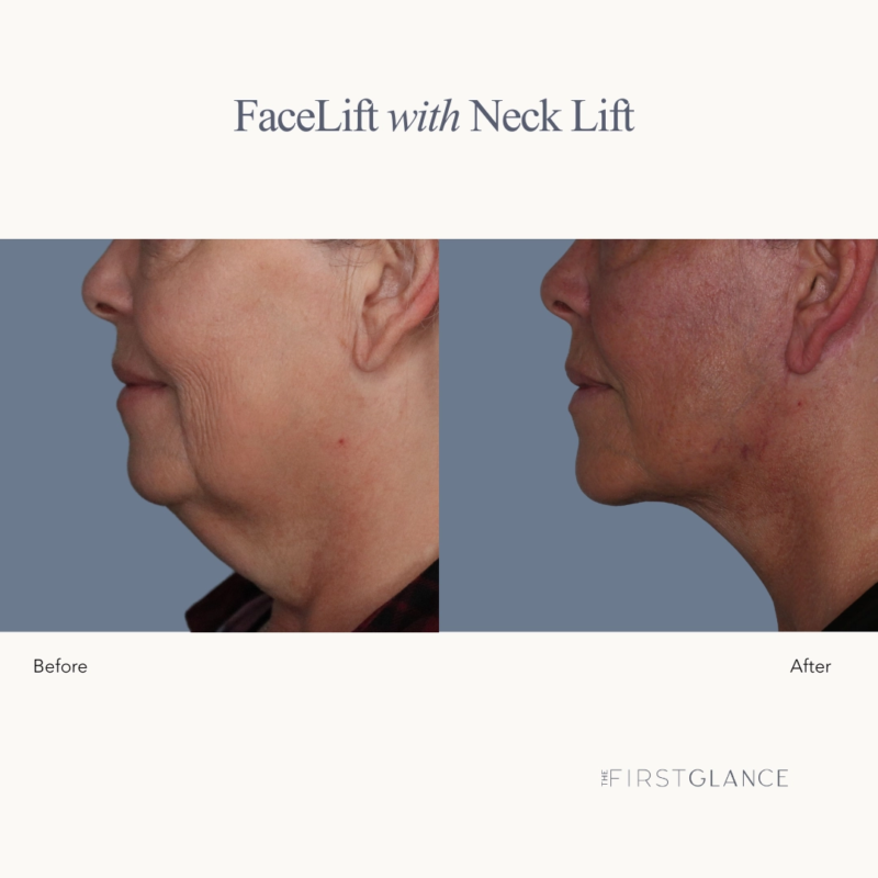 FaceLift & Neck Lift Photos Before & After Winnipeg, Manitoba, Canada Plastic Surgeon